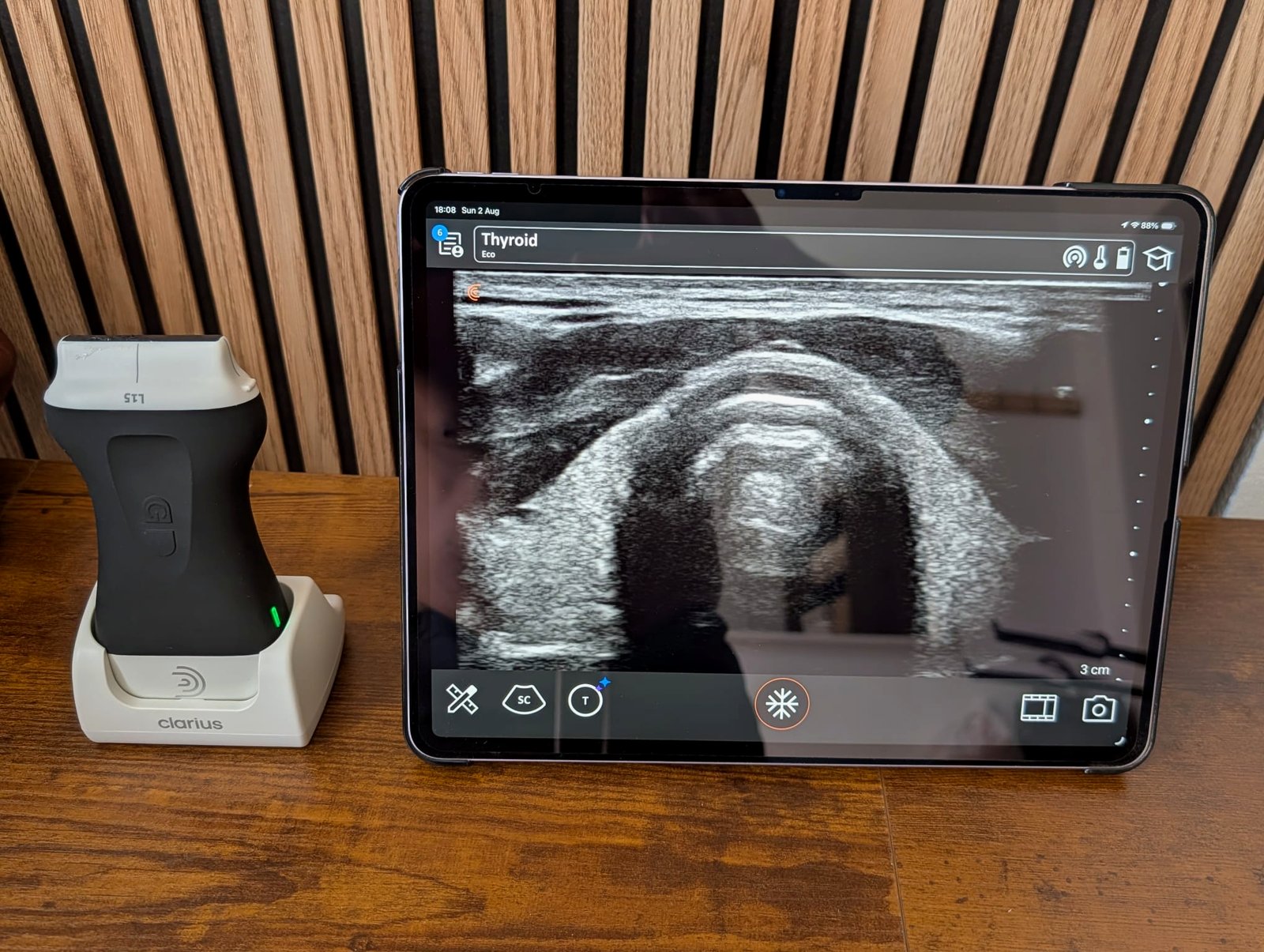 Portable ultrasound probe on its dock beside a tablet showing a live thyroid scan